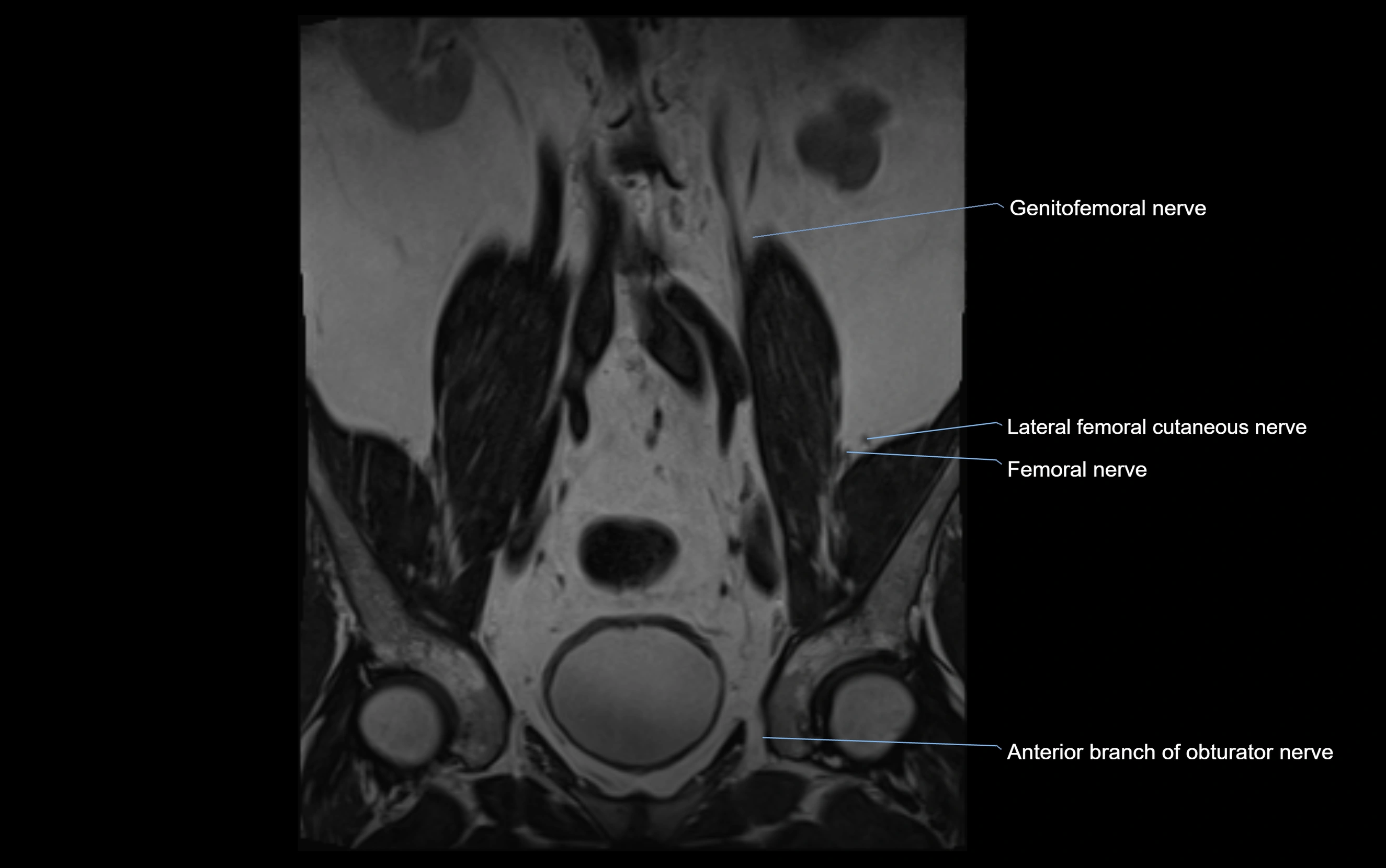 MR lumbosacral plexus cross sectional anatomy 3T  radiology  image-img-09001-00010.webp